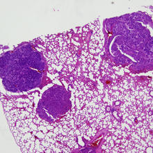 Section of lung tissue from a double knockout mouse, stained to show lung tumors. 