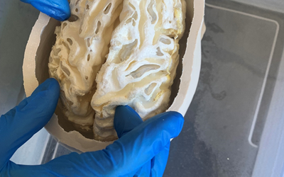 white matter mimic in the bottom half of the artificial cranium