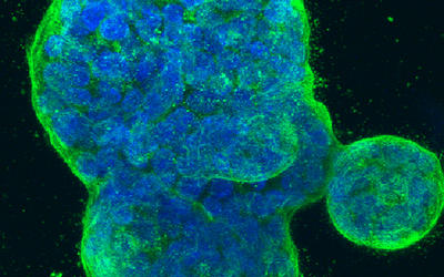 Three-dimensional culture of human breast cancer cells, with DNA stained blue and a protein in the cell surface membrane stained green.