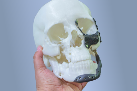 A model skull with additively manufactured facial prosthetics lining the jaw, chin, and cheek bone areas. The skull is held up for the camera.  