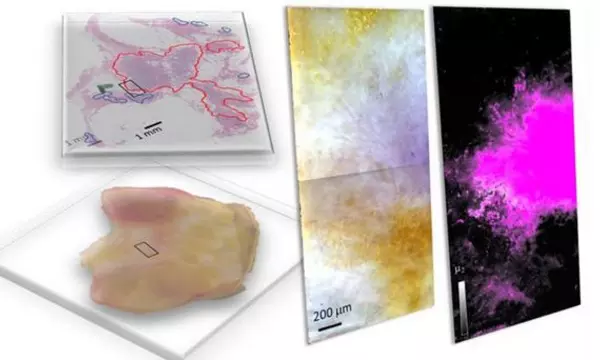 Freshly dissected tissue (lower left) and its pathology-prepared slide with identified tumor regions by a pathologist (upper left), and a pseudo-color image of hyperspectral dark-field microscopy (HSDFM) data cube (middle) region marked on the tissue images on the left.